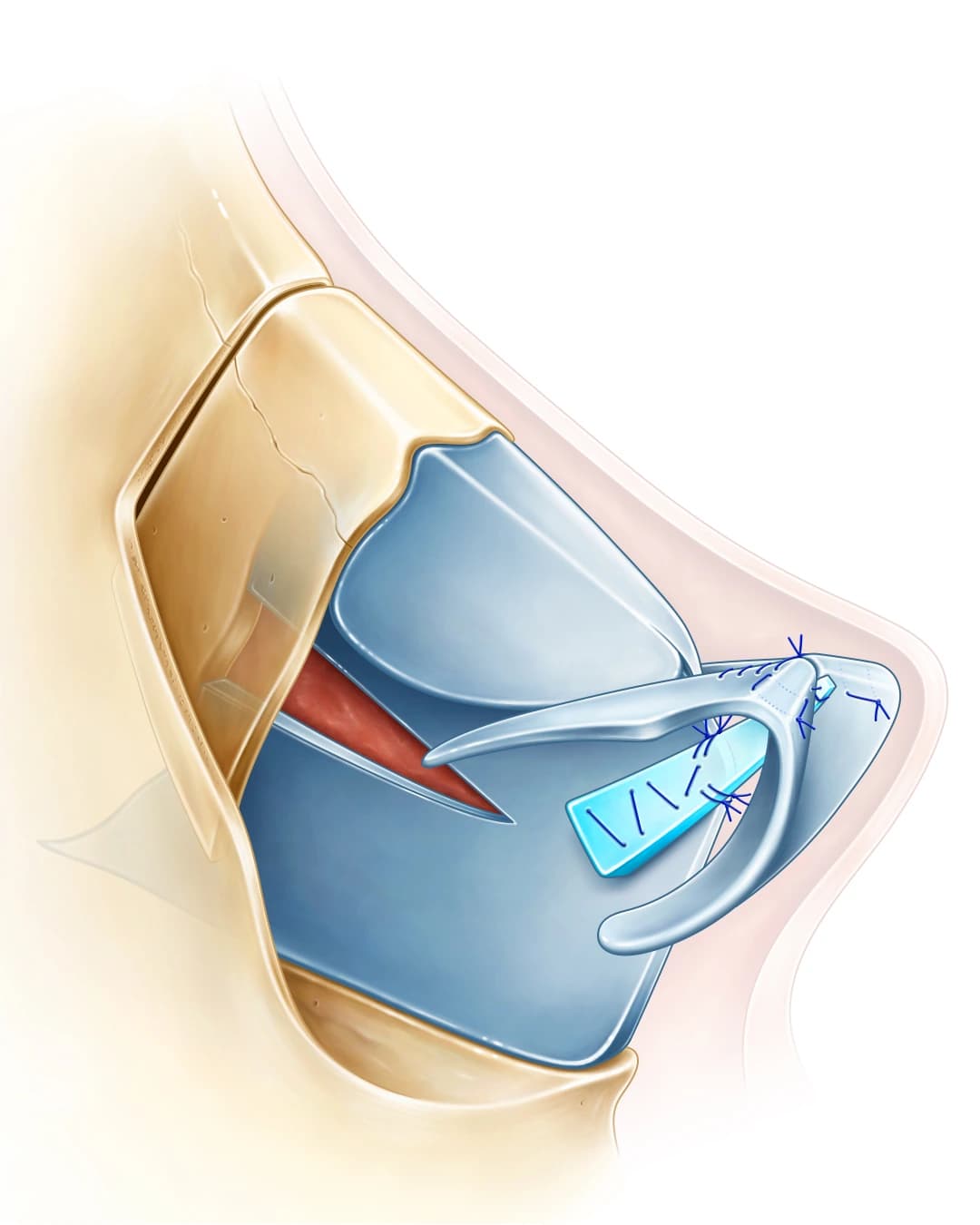 Surgical anatomy illustration showing the nasal septum, cartilage framework and structural grafts