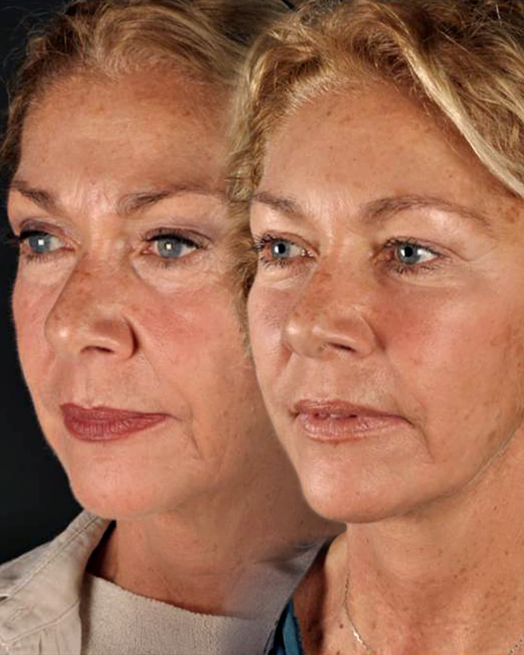 Facelift surgery candidate consultation at Teo Clinic Istanbul