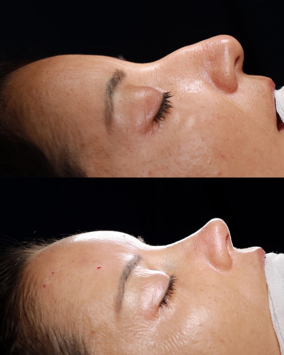 Fat Injection + Primary Rhinoplasty