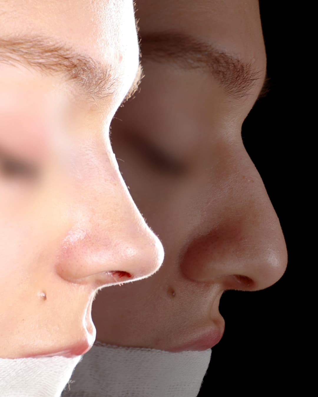 Primary Rhinoplasty Patient 1